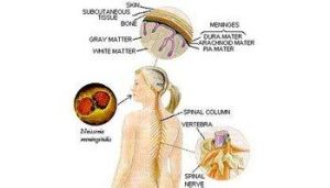 小兒原髮型肺結核 小兒原髮型肺結核