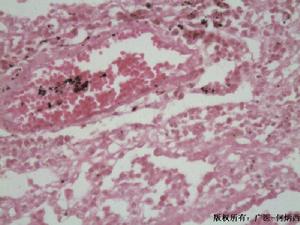 Α1抗胰蛋白酶缺乏性肝病