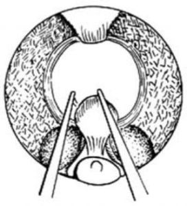 經尿道前列腺電切術 經尿道前列腺電切術