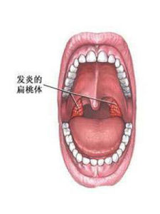 化膿性扁桃體炎 化膿性扁桃體炎