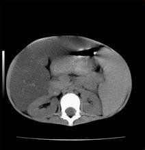 肝脂肪浸潤 肝脂肪浸潤