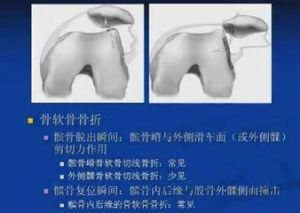 急性髕骨脫位 急性髕骨脫位