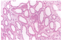 膀胱-輸尿管反流綜合徵