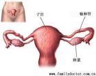卵巢腫瘤