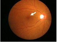 黃斑裂孔 黃斑裂孔