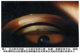 Axenfeld-Rieger綜合徵 Axenfeld-Rieger綜合徵