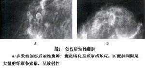 外傷性乳房脂肪壞死