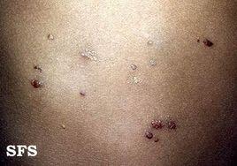 血管淋巴管瘤 血管淋巴管瘤