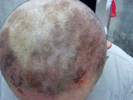 頑固性皮膚病 頑固性皮膚病