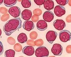 急性非淋巴細胞白血病