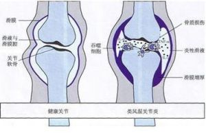 絕經期關節炎 絕經期關節炎