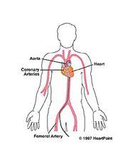 漂浮導管插入術圖解