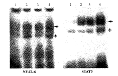 多發性骨髓瘤病腎病
