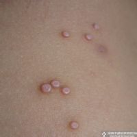 毛孔堵塞 毛孔堵塞