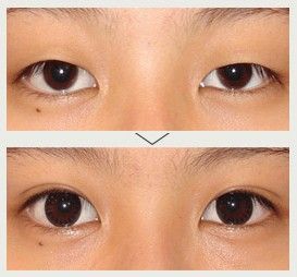 麗都3D動態重瞼術 麗都3D動態重瞼術