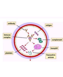 三型超敏反應 三型超敏反應
