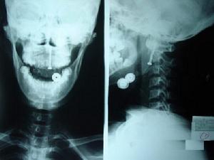 樞椎齒狀突骨折