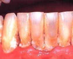 牙齦病 牙齦病