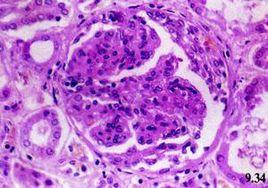 緩進性腎孟腎炎 緩進性腎孟腎炎