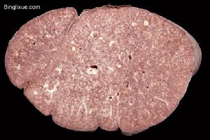急性間質性肺炎