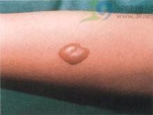 皮下結節 皮下結節