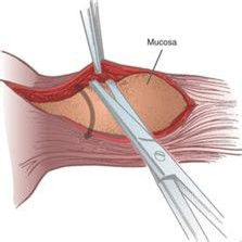 賁門失遲緩症 賁門失遲緩症