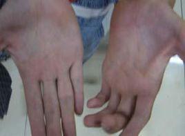 手內肌萎縮 手內肌萎縮