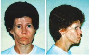 偏側萎縮症 偏側萎縮症