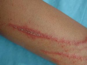 甲蟲皮炎 甲蟲皮炎