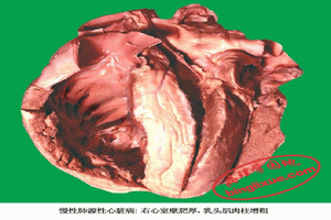 急性肺源性心臟病