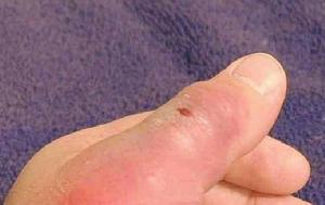 毒蜘蛛咬傷 毒蜘蛛咬傷