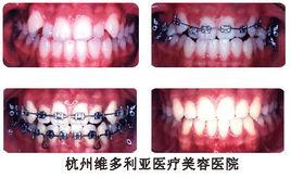 矯正齙牙術 矯正齙牙術