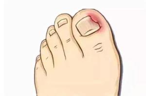 指甲嵌入肉 指甲嵌入肉