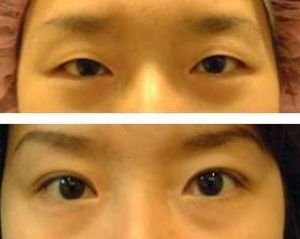 切雙眼皮 切雙眼皮