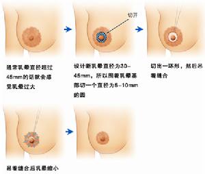 乳頭整形