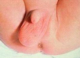 無痛性陰囊內腫塊 無痛性陰囊內腫塊