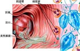 子宮瘀毒 子宮瘀毒