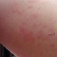 慢性尋麻疹 慢性尋麻疹