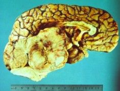 松果體腦瘤 松果體腦瘤