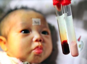 新生兒患病血液呈乳白色