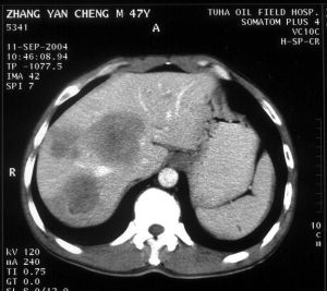 骶骨腫瘤 骶骨腫瘤