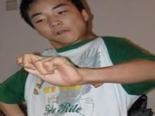 小兒變形性肌張力障礙 小兒變形性肌張力障礙