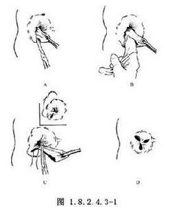 外剝內扎術 外剝內扎術