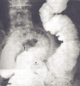 過敏性結腸炎 過敏性結腸炎