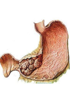 傾倒綜合徵 傾倒綜合徵