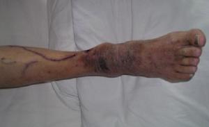 血栓性淺靜脈炎 血栓性淺靜脈炎