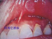 復發性阿弗它潰瘍 復發性阿弗它潰瘍