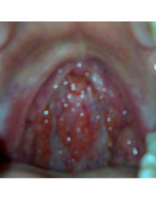 慢性單純性咽炎