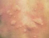 過敏蕁麻疹 過敏蕁麻疹