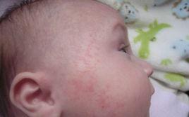 牛奶蛋白過敏 牛奶蛋白過敏